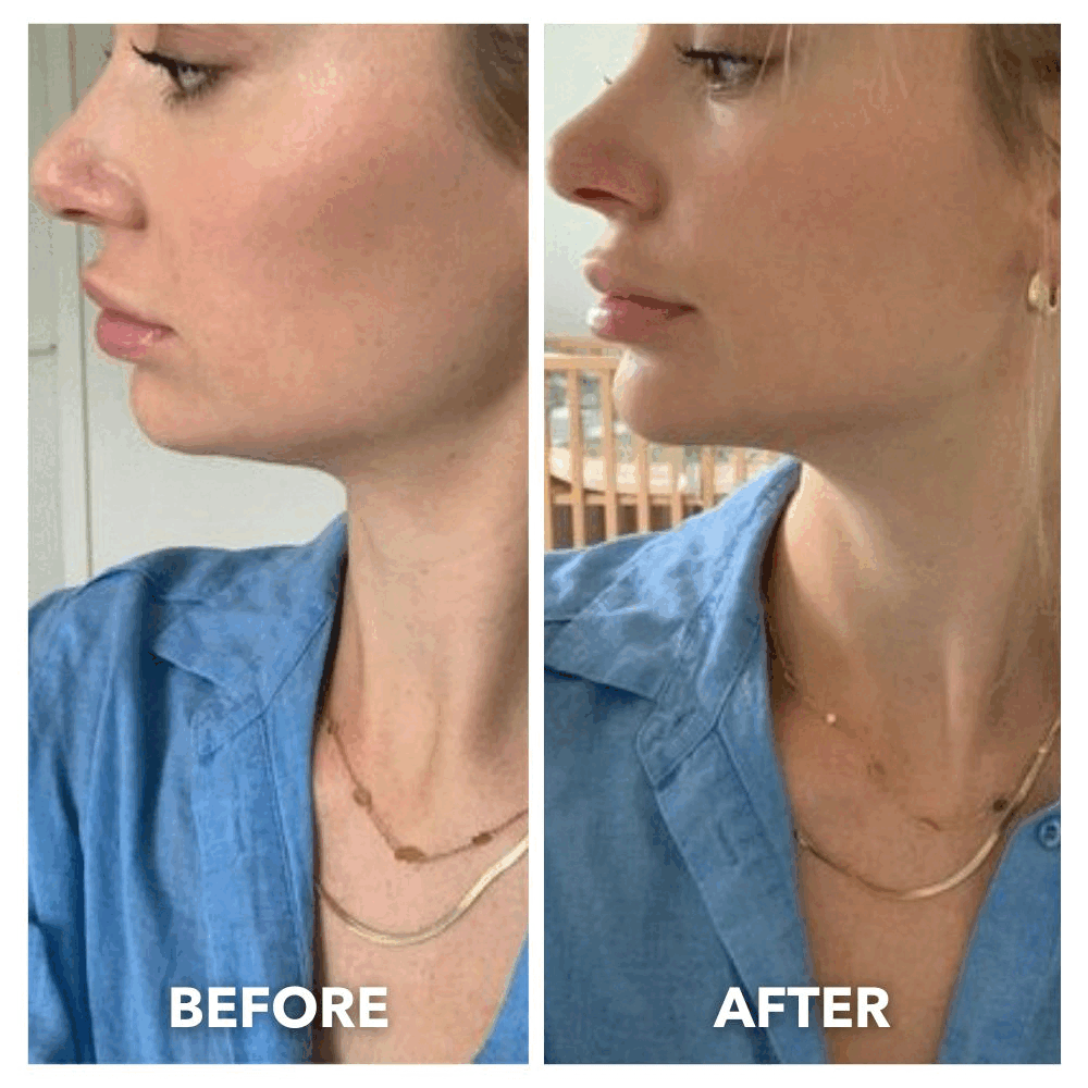 V-Line Lifting Chinstrap